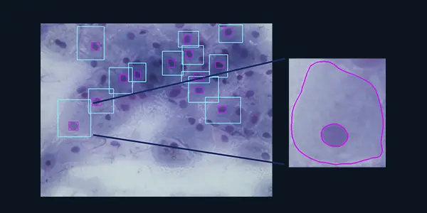 Desarrollan herramientas de aprendizaje profundo para apoyar el diagnóstico oportuno de este padecimiento mediante el análisis automatizado de imágenes citológicas